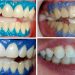 Clínica da Drª Shara Moreno vem alcançando ótimos resultados em clareamento dental