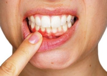 Maio Vermelho alerta para prevenção e diagnóstico precoce do câncer de boca em Rondônia